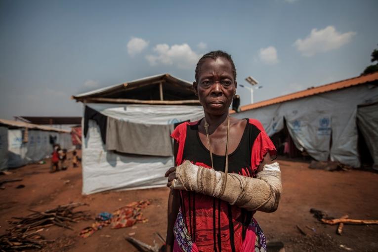 Une femme réfugiée dans le camp de Cacanda en Angola en juillet 2017. Elle a été blessée lors de combats dans la région du Kasaï en RDC.