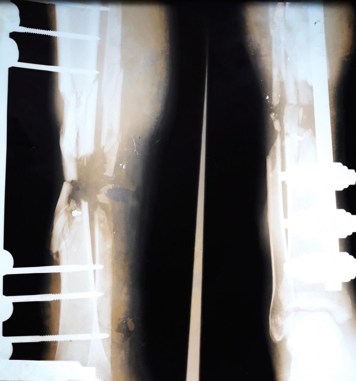 Radiographie des jambes d'Eyad, un Palestinien de 22 ans. La fracture de l'os de sa jambe droite nécessite de nombreuses opérations chirurgicales.
 © Alva Simpson White/MSF