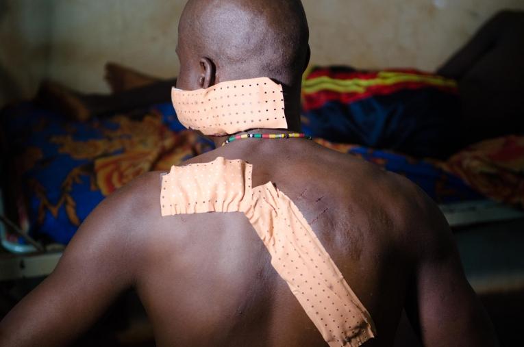 Dieudonné R.vivait à Gambo lorsque le conflit à éclaté. Il à été attaqué à la machette par des combattants.
 © Natacha Buhler/MSF