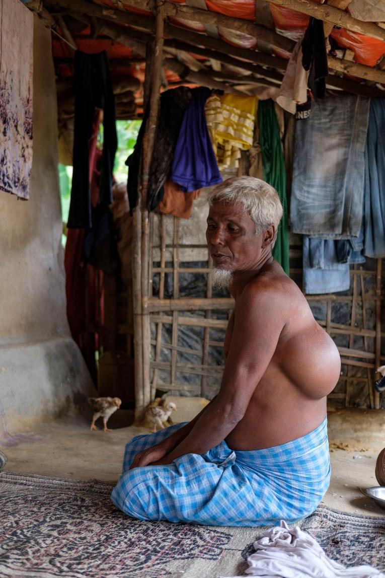 Homme de 61 ans originaire de Buthidaung présentant une importante protubérance de tissus mous dans le dos et sur la gorge.
 © Antonio Faccilongo