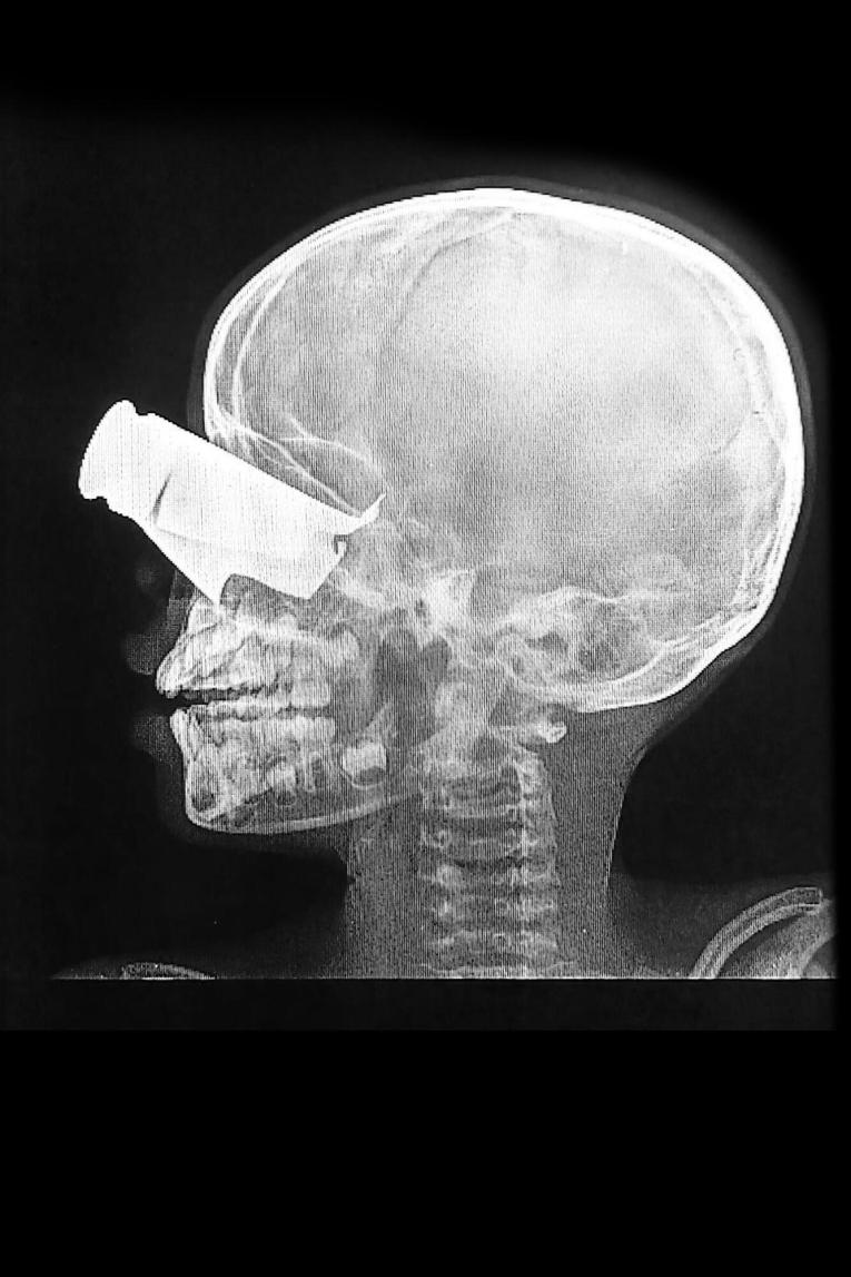 Radiographie d'un garçon de neuf ans, à la suite d'une attaque de drone dans l'ouest du Soudan.
 © MSF