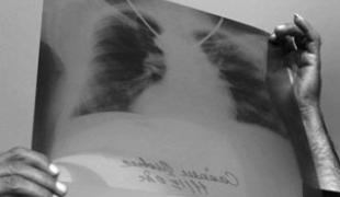 En dépit de son caractère épidémique et du problème de santé publique mondiale qu'elle pose la tuberculose demeure une maladie négligée. A l'occasion de la journée mondiale de lutte contre la tuberculose MSF qui a soigné plus de 30 000 personnes