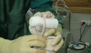 Pose d'une attelle sur une main brûlée